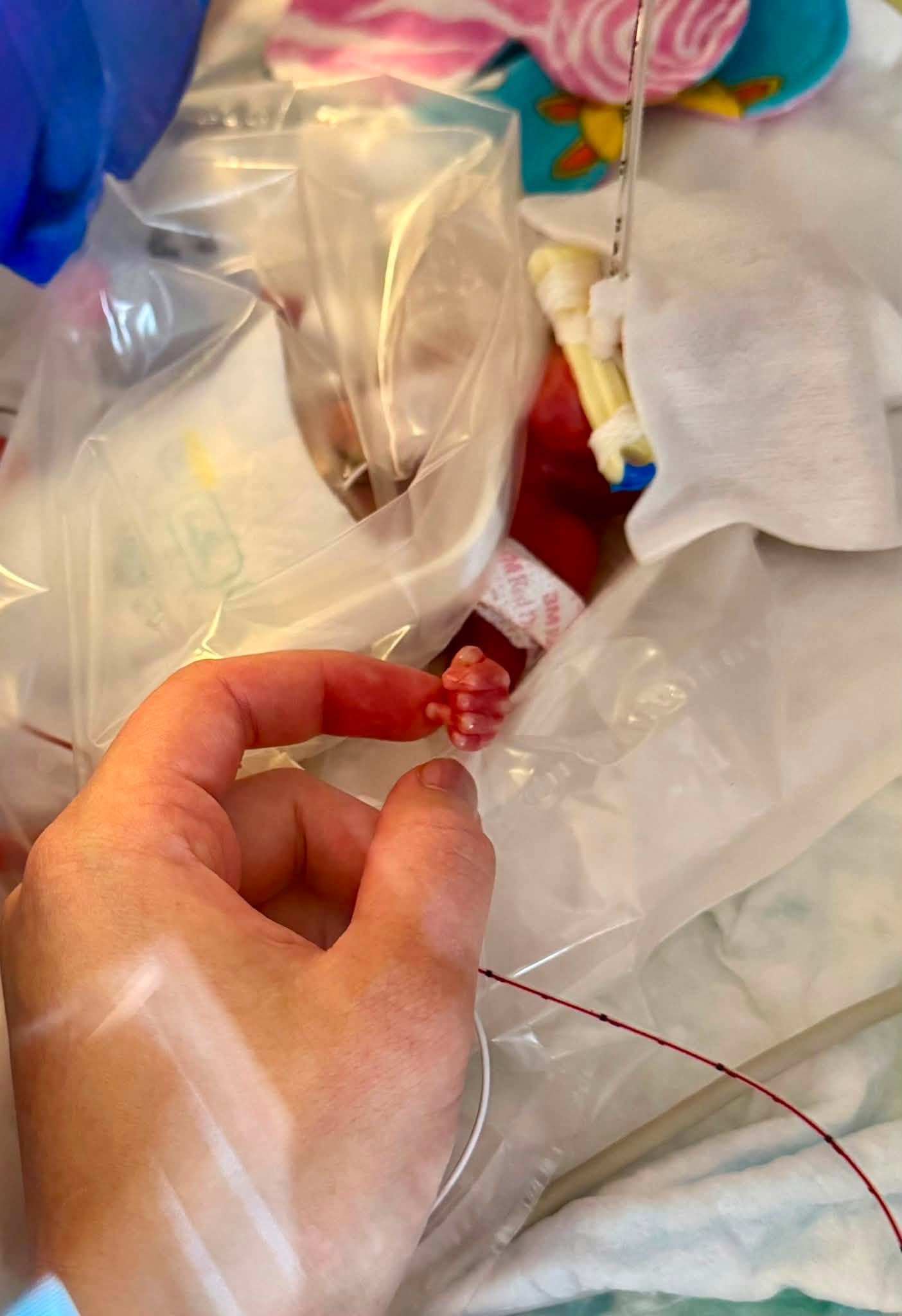 Wisconsin Baby, Born at 12.5 Ounces, Discharged After 375 Days in NICU