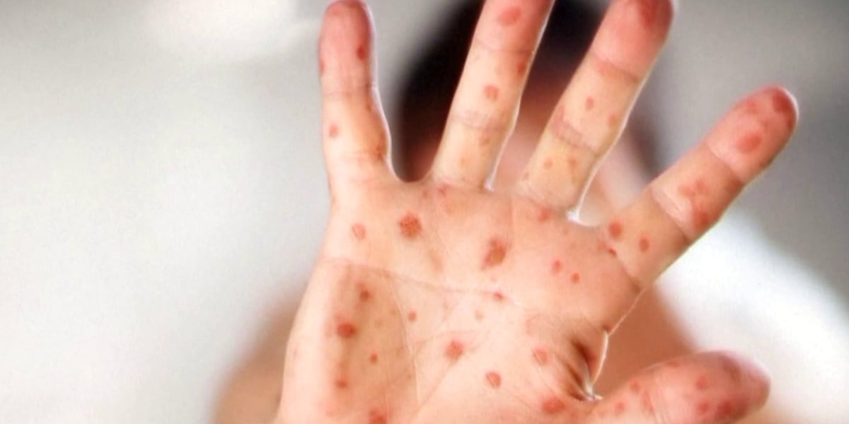 Measles Exposure Alert: Kansas Health Officials Investigate Potential Cases at Wichita's Wesley Medical Center
