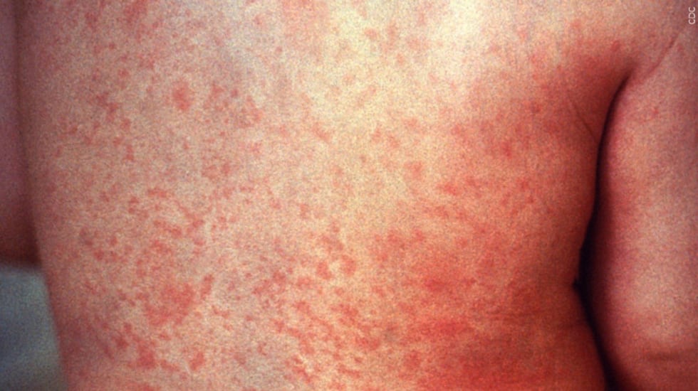 Measles cases are rising in the U.S., the CDC reports.